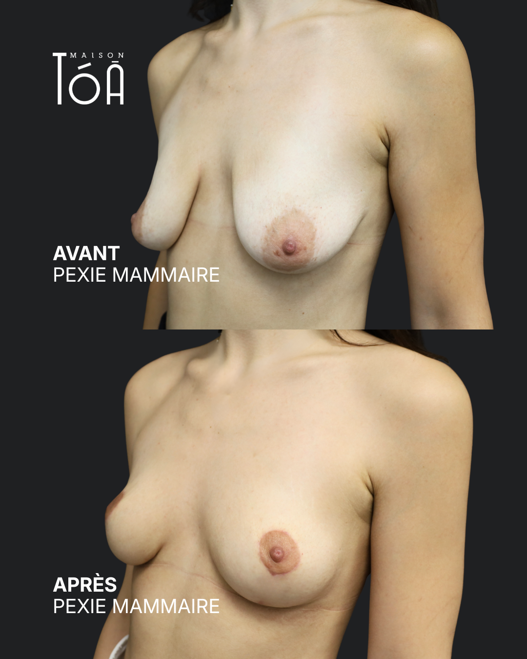 Breast lift before/after, result 4, Maison Tóā Lausanne