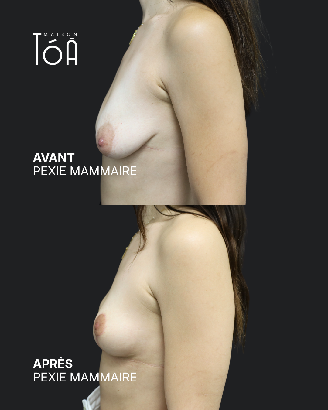 Breast lift before/after, result 5, Maison Tóā Lausanne