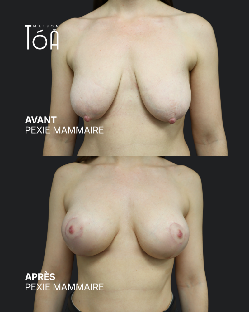 Breast lift before/after, result 9, Maison Tóā Lausanne