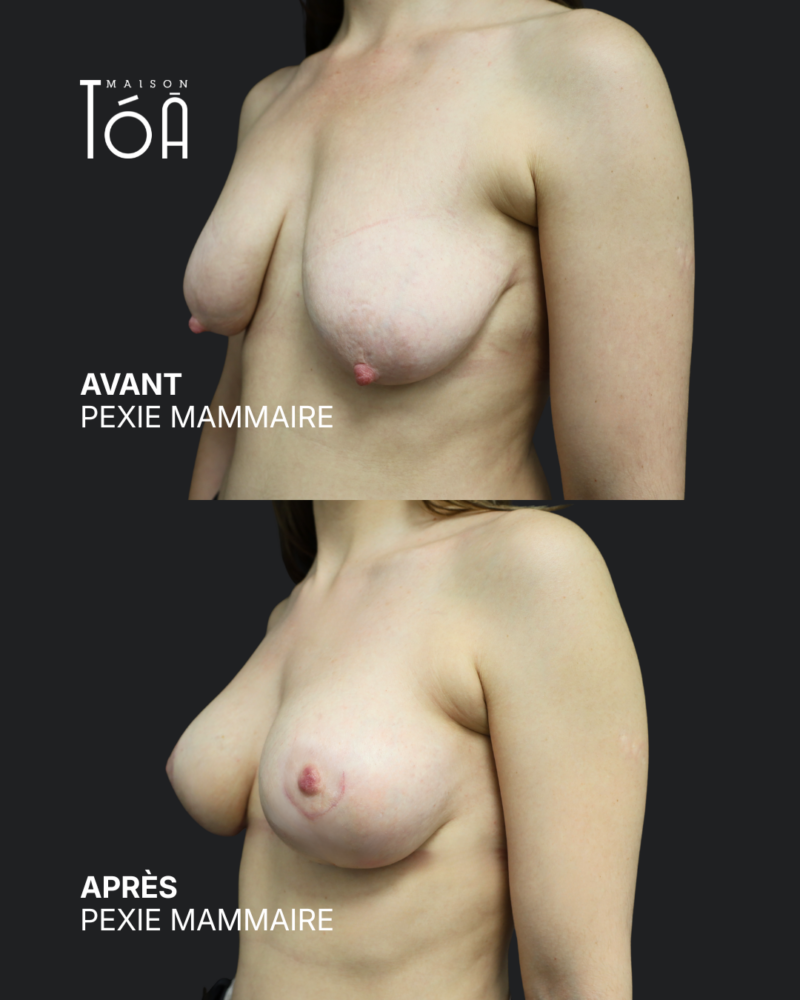 Breast lift before/after, result 6, Maison Tóā Lausanne