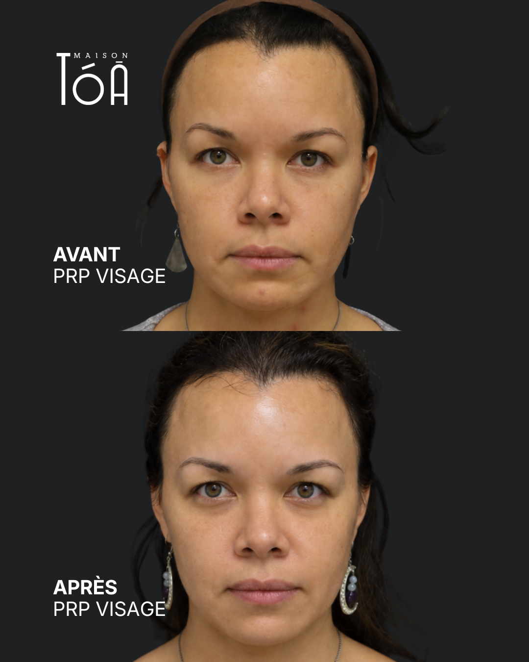 PRP Visage 9 PRP visage avant après
