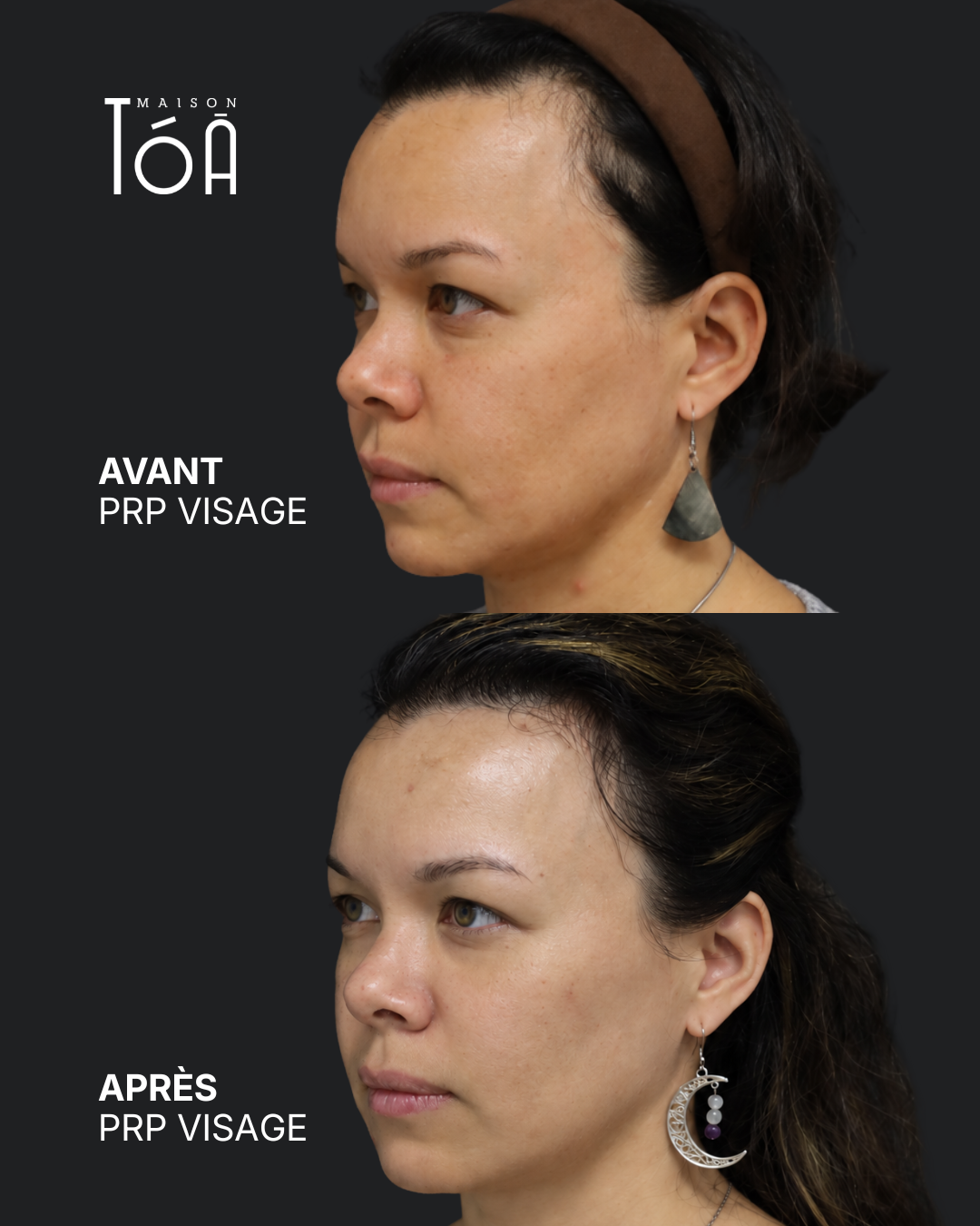 PRP Visage 10 PRP visage avant après