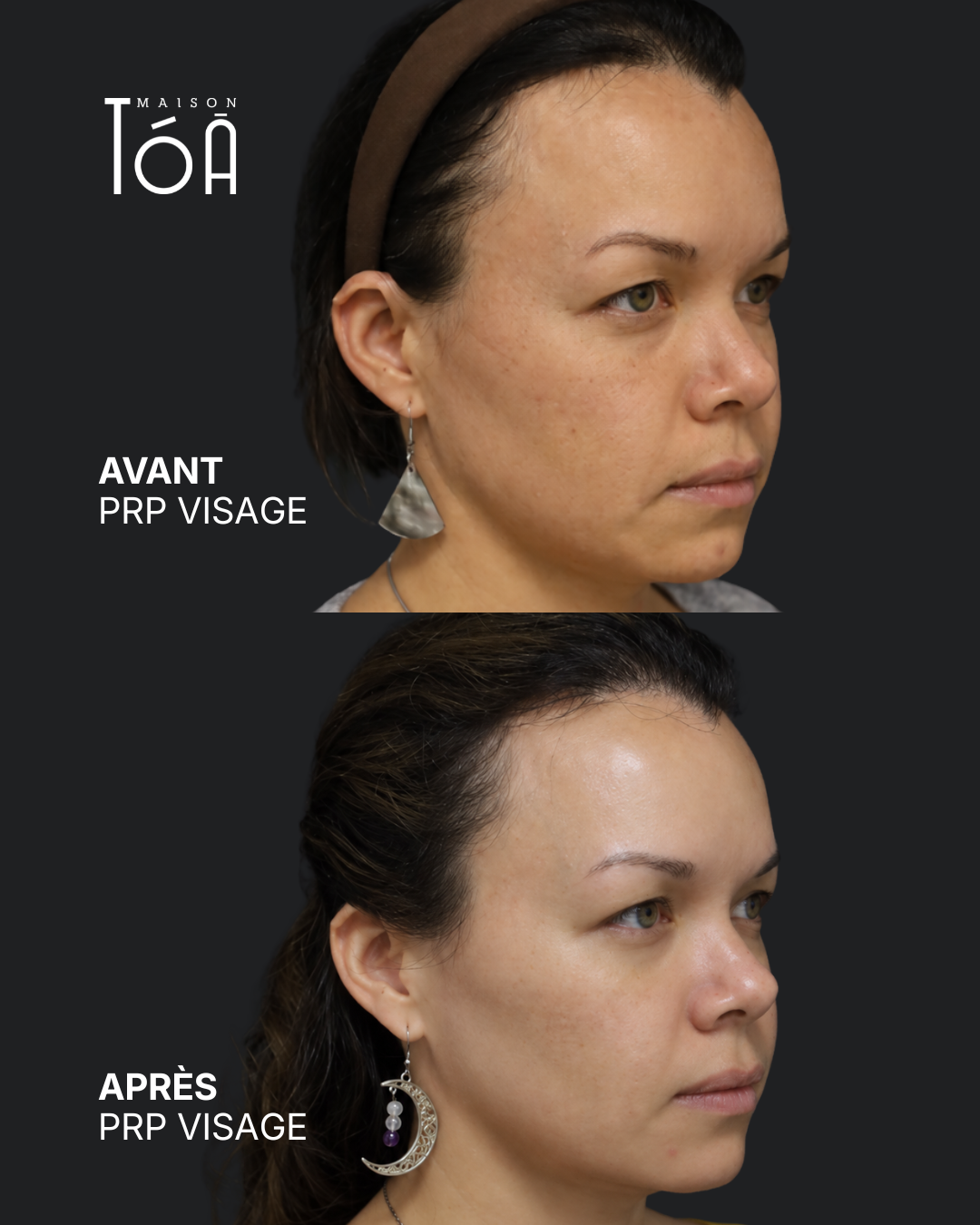 PRP Visage 8 PRP visage avant après