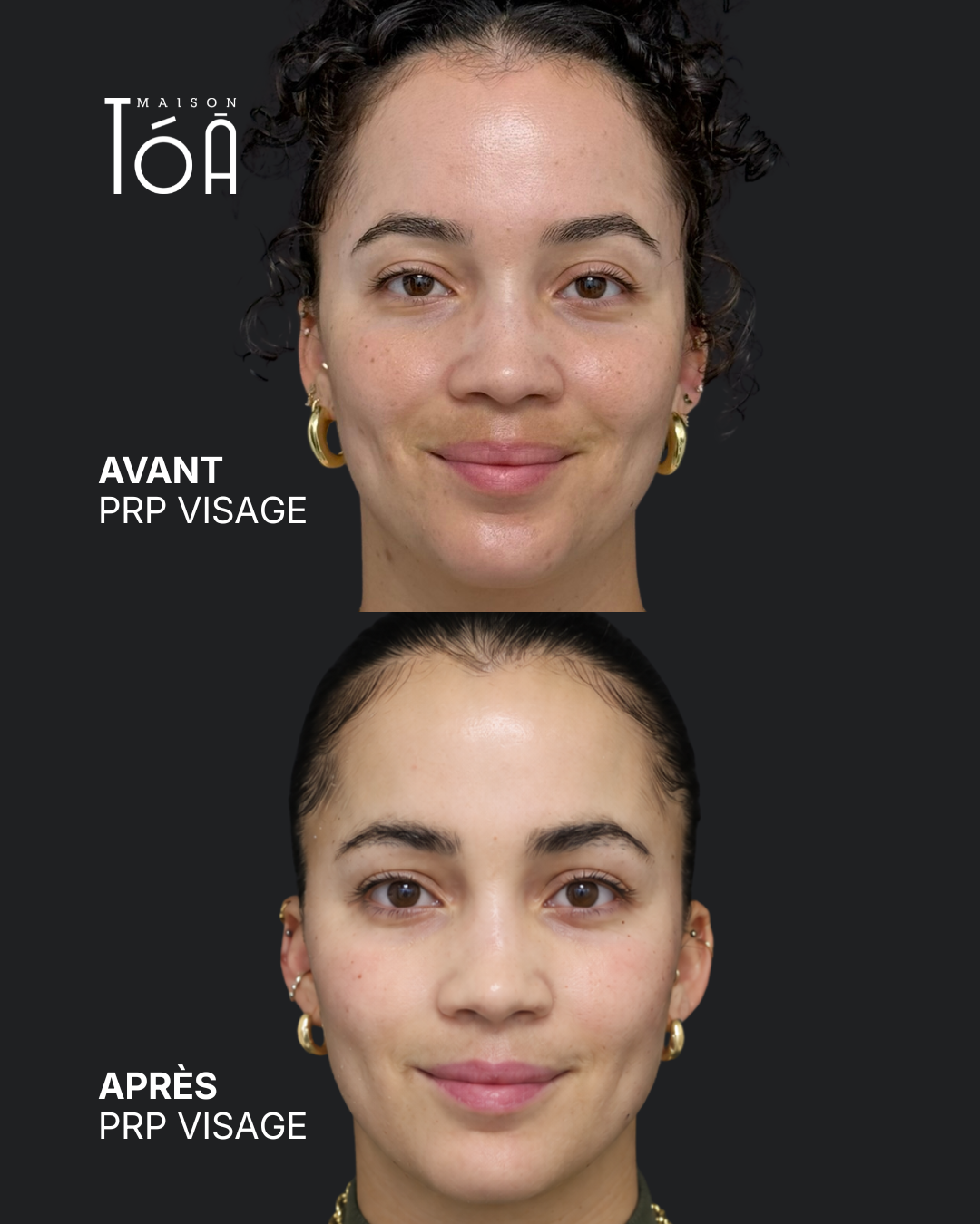 PRP Visage 6 PRP visage avant après