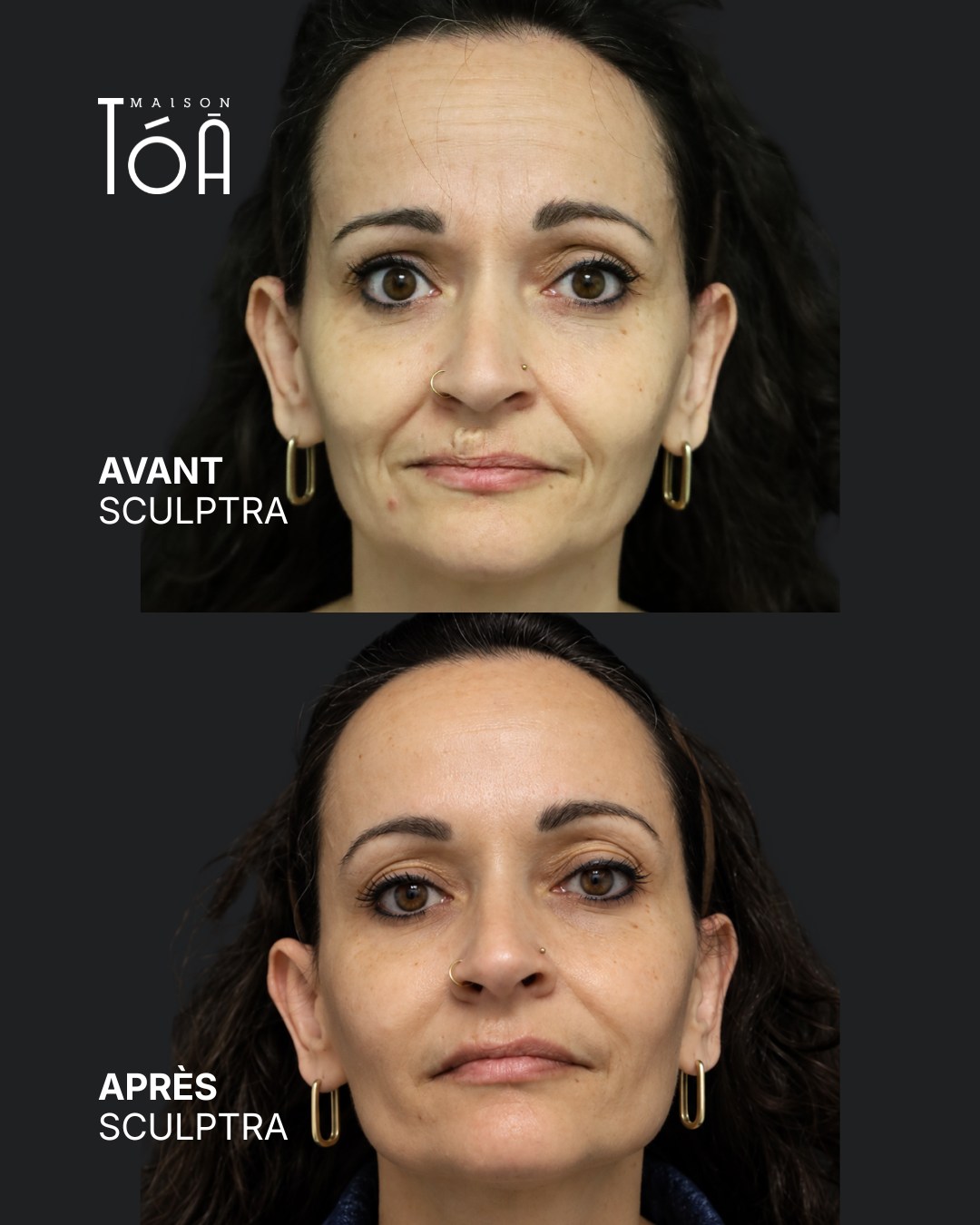 Sculptra 8 Avant Après scuptra