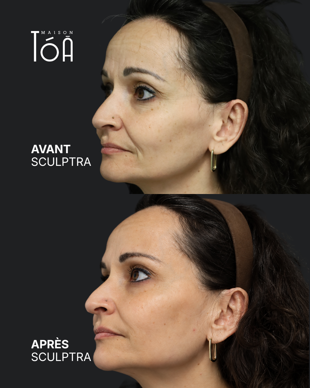 Sculptra 10 Avant Après sculptra