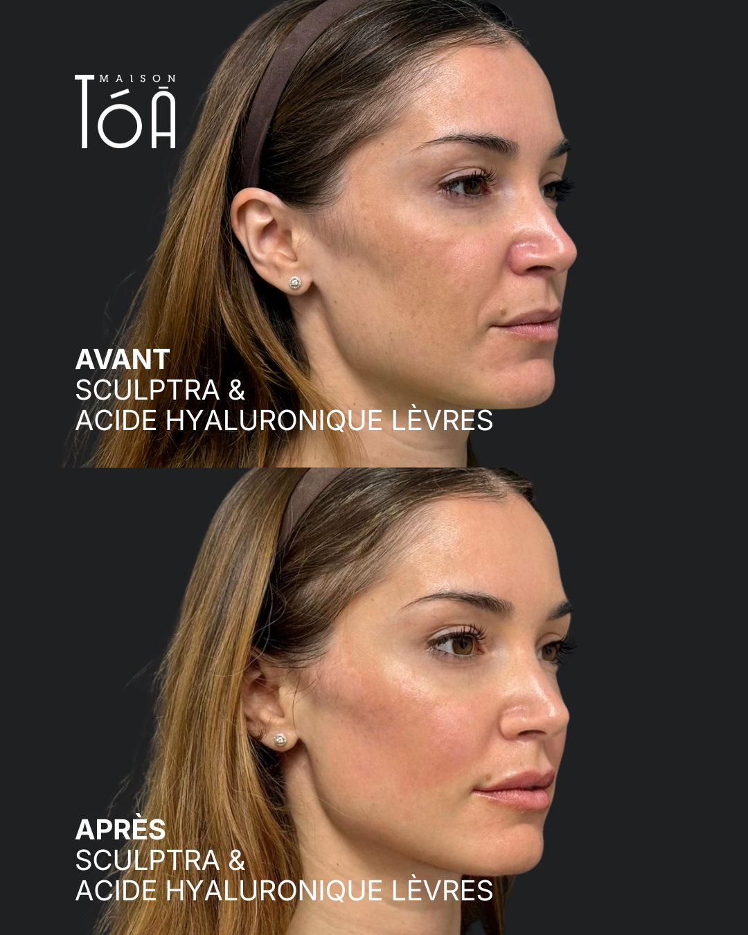 Sculptra 7 sculptra Après profhilo