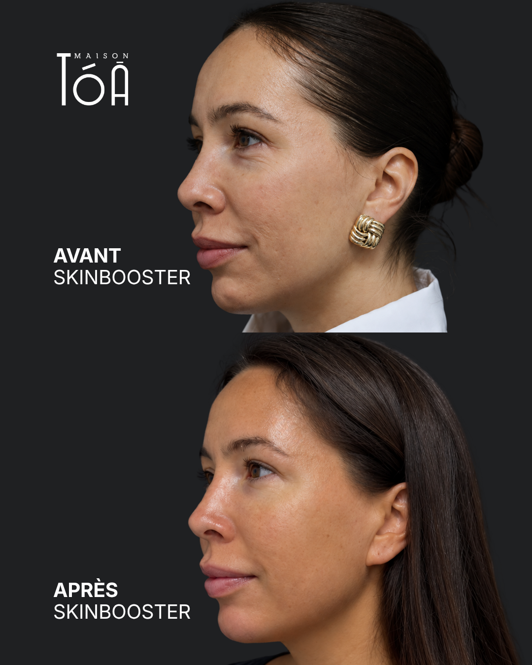 Skinbooster 7 Skinbooster avant / après — cas 2, Maison Tóā Lausanne