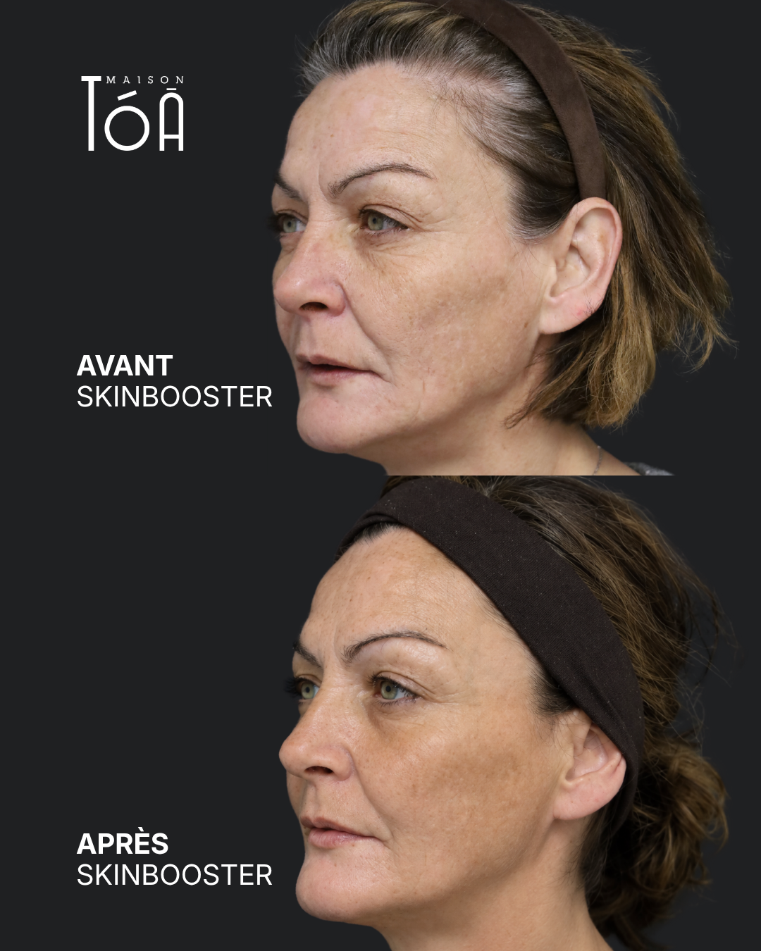 Skinbooster 9 avant apres skinbooster 4
