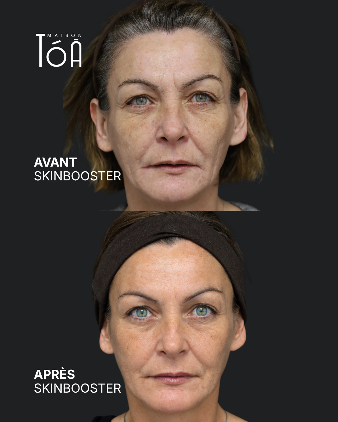 Skinbooster 8 avant apres skinbooster 5