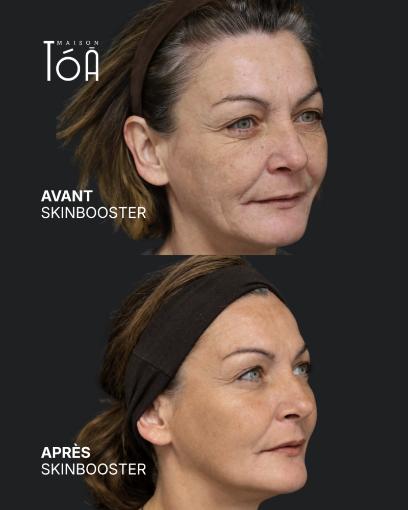 Skinbooster 10 avant apres skinbooster 6 e1790158876930