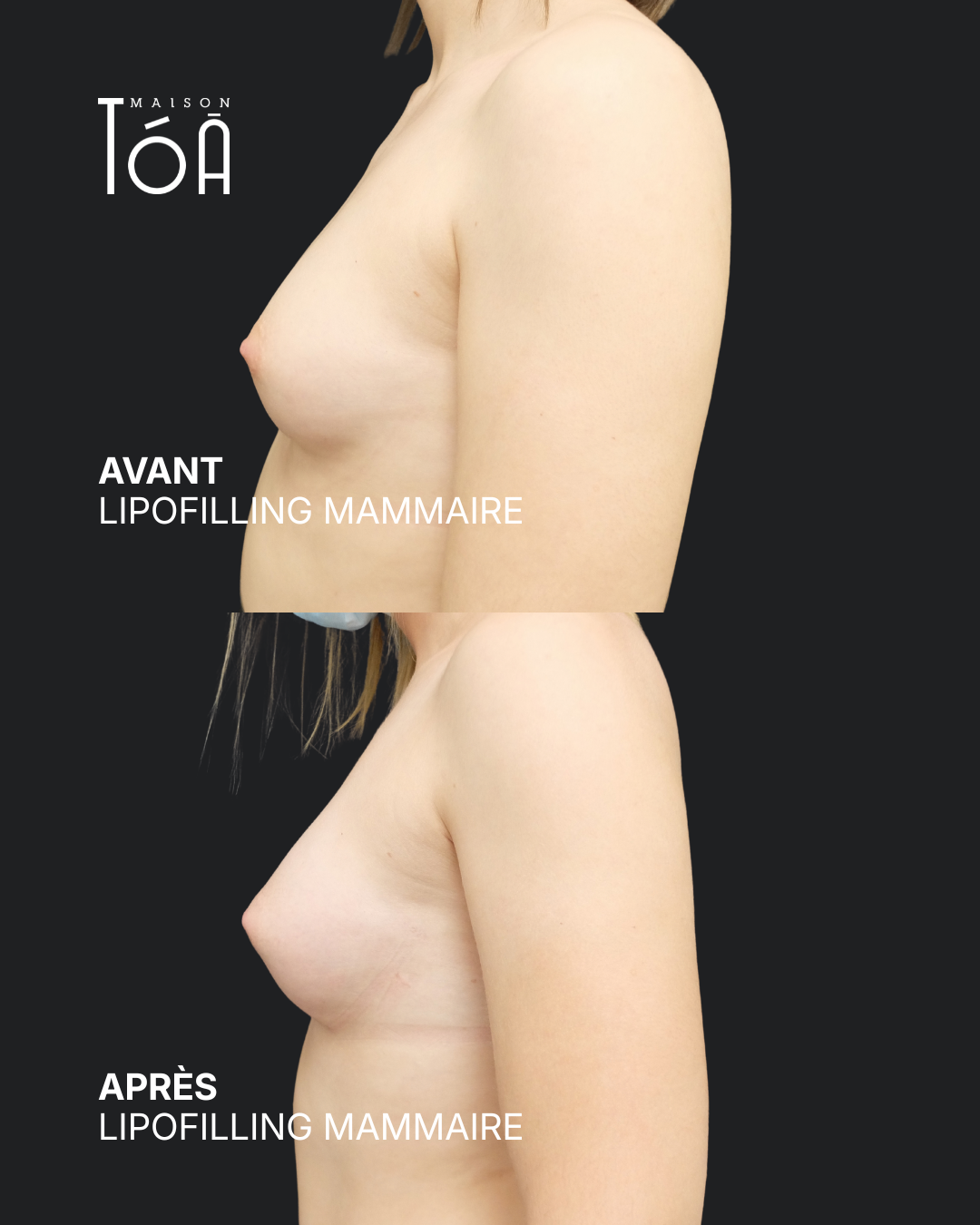 Breast lipofilling 8 Breast lipofilling before/after, result 4, Maison Tóā Lausanne