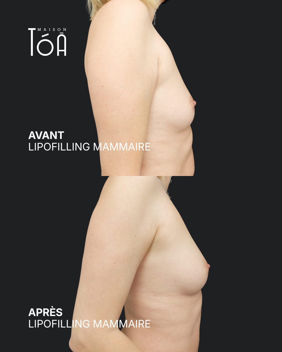 Breast lipofilling 14 Breast lipofilling before/after, result 10, Maison Tóā Lausanne