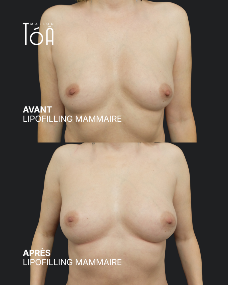 Breast lipofilling 11 Breast lipofilling before/after, result 7, Maison Tóā Lausanne