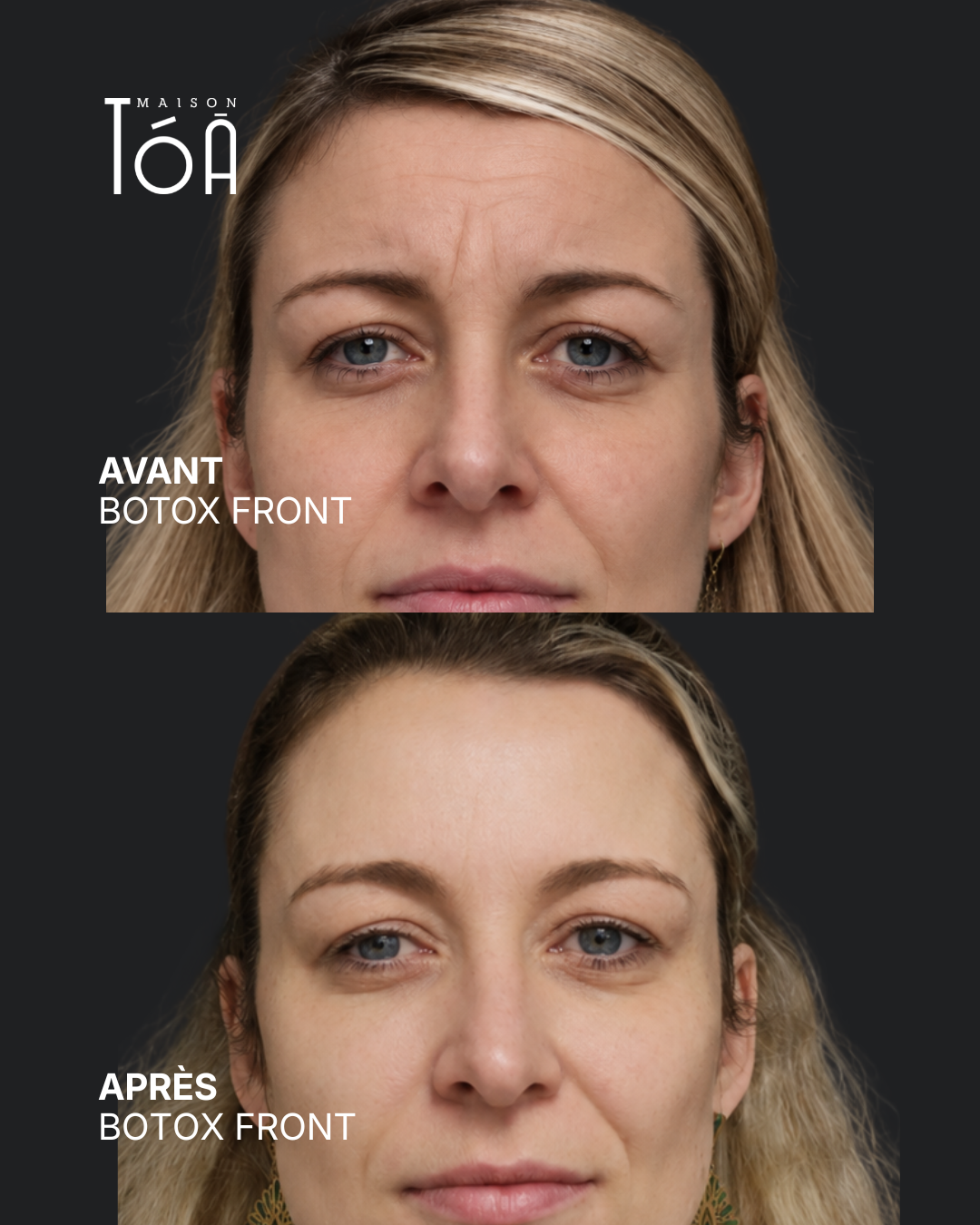 Botox 8 Avant/après toxine botulique, résultat 3, Maison Tóā Lausanne