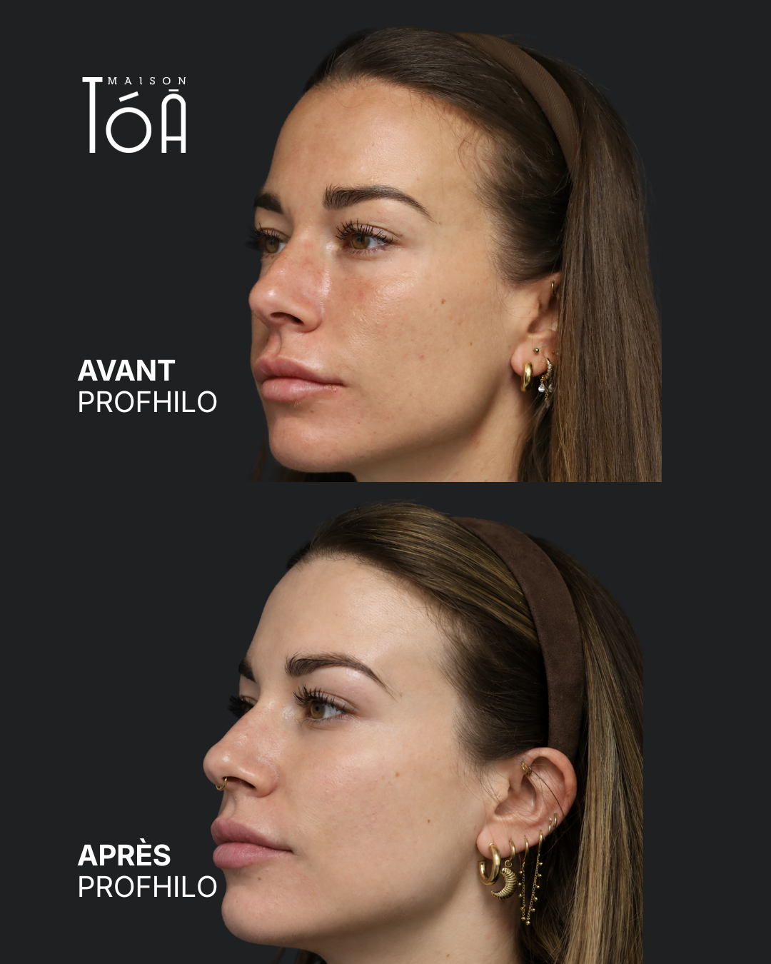 Profhilo® 7 Avant Après profhilo
