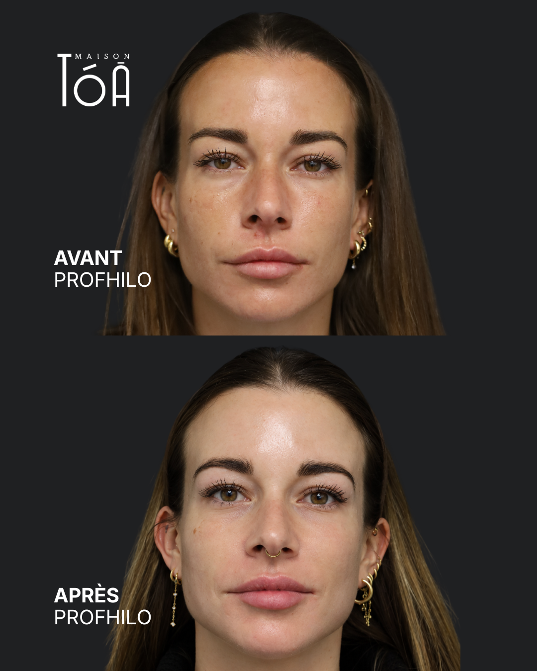 Profhilo® 5 Avant Après profhilo