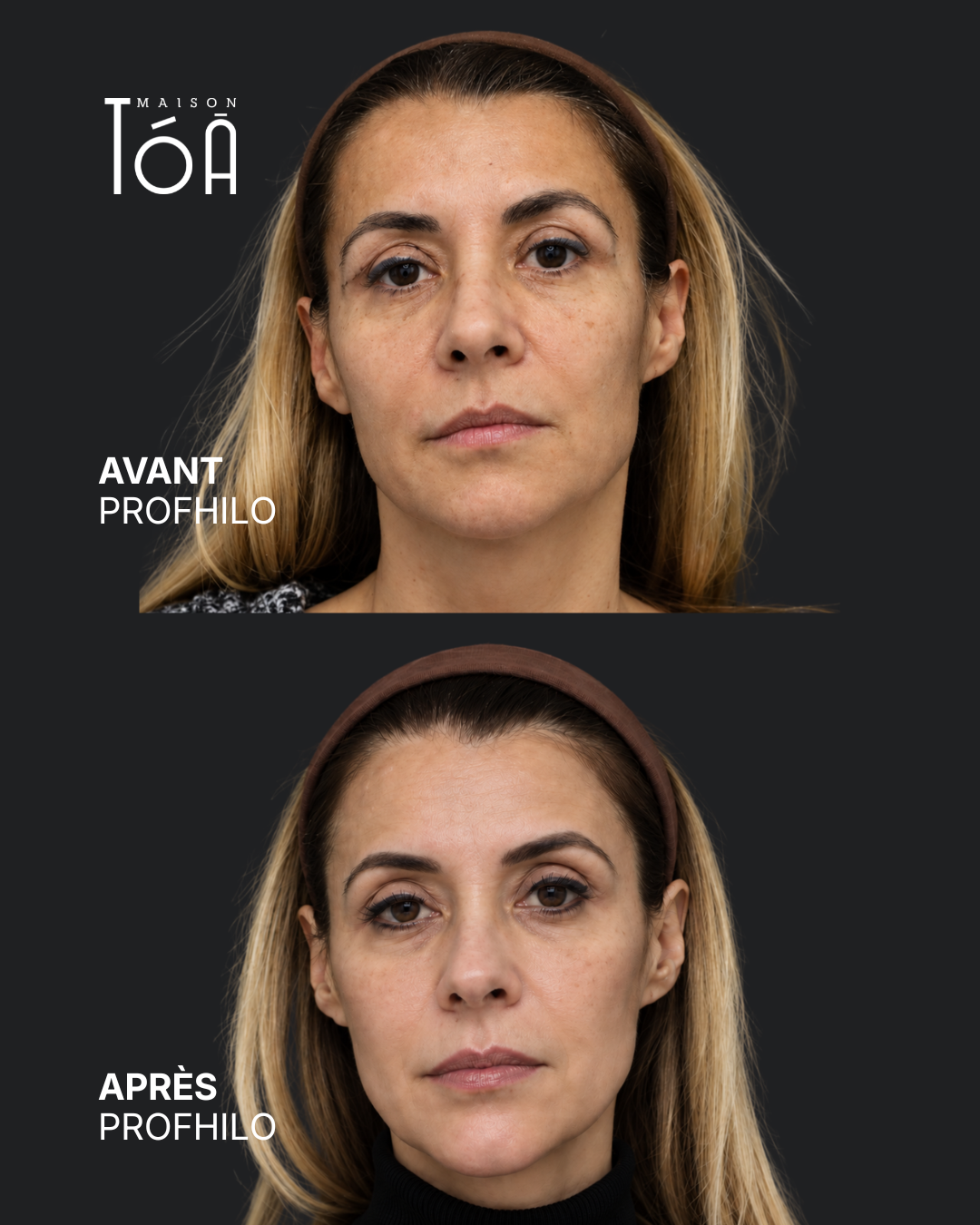 Profhilo® 10 profhilo lausanne