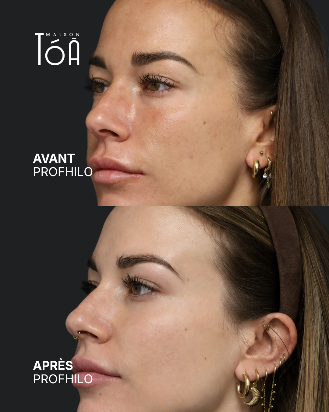 Profhilo® 8 Avant Après profhilo