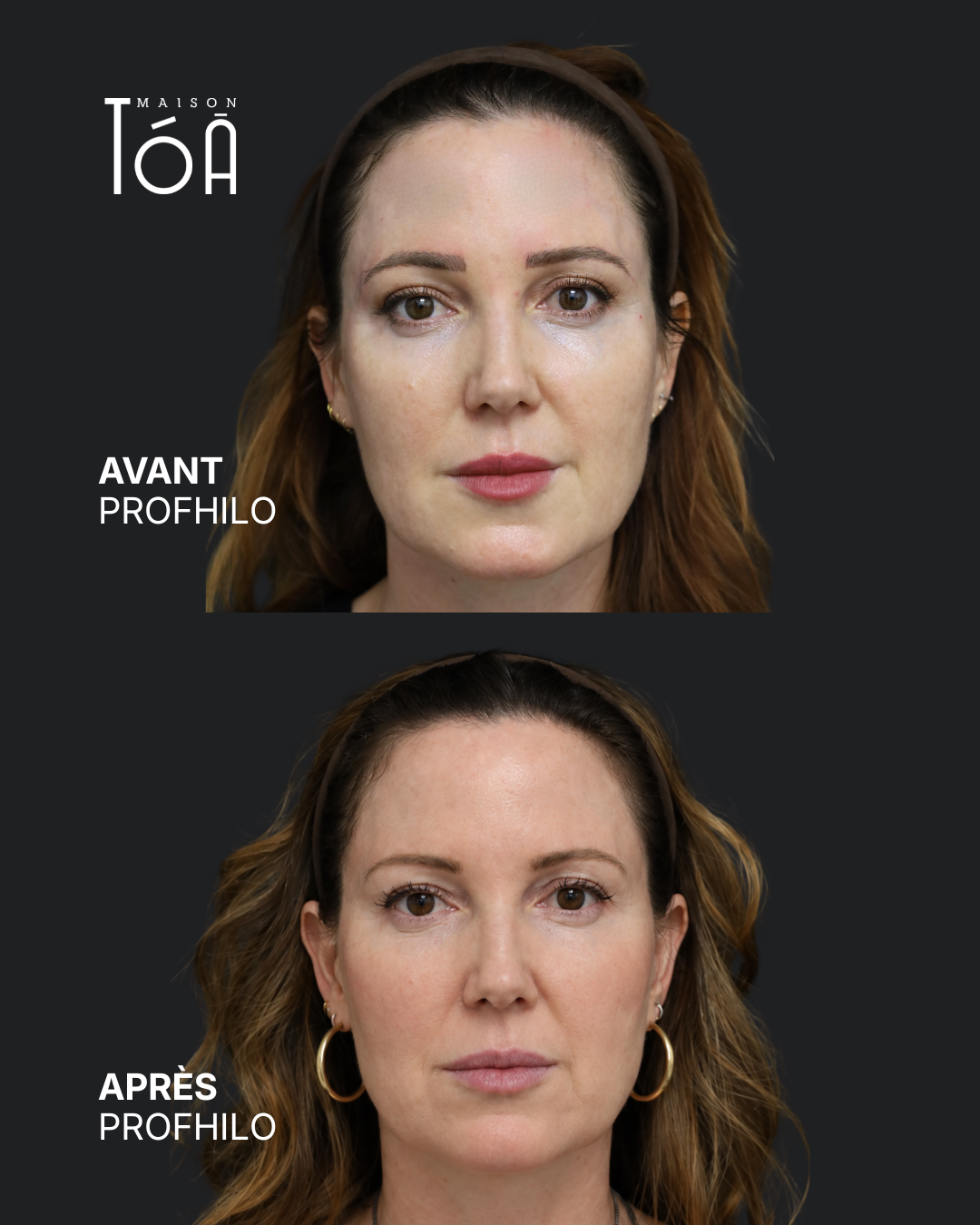 Profhilo® 5 Avant Après profhilo