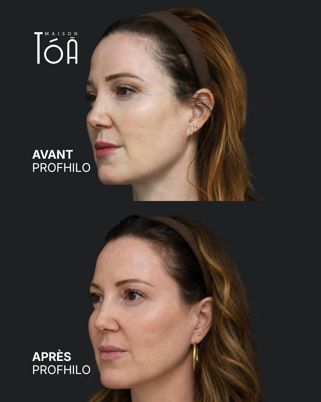 Profhilo® 6 Avant Après profhilo
