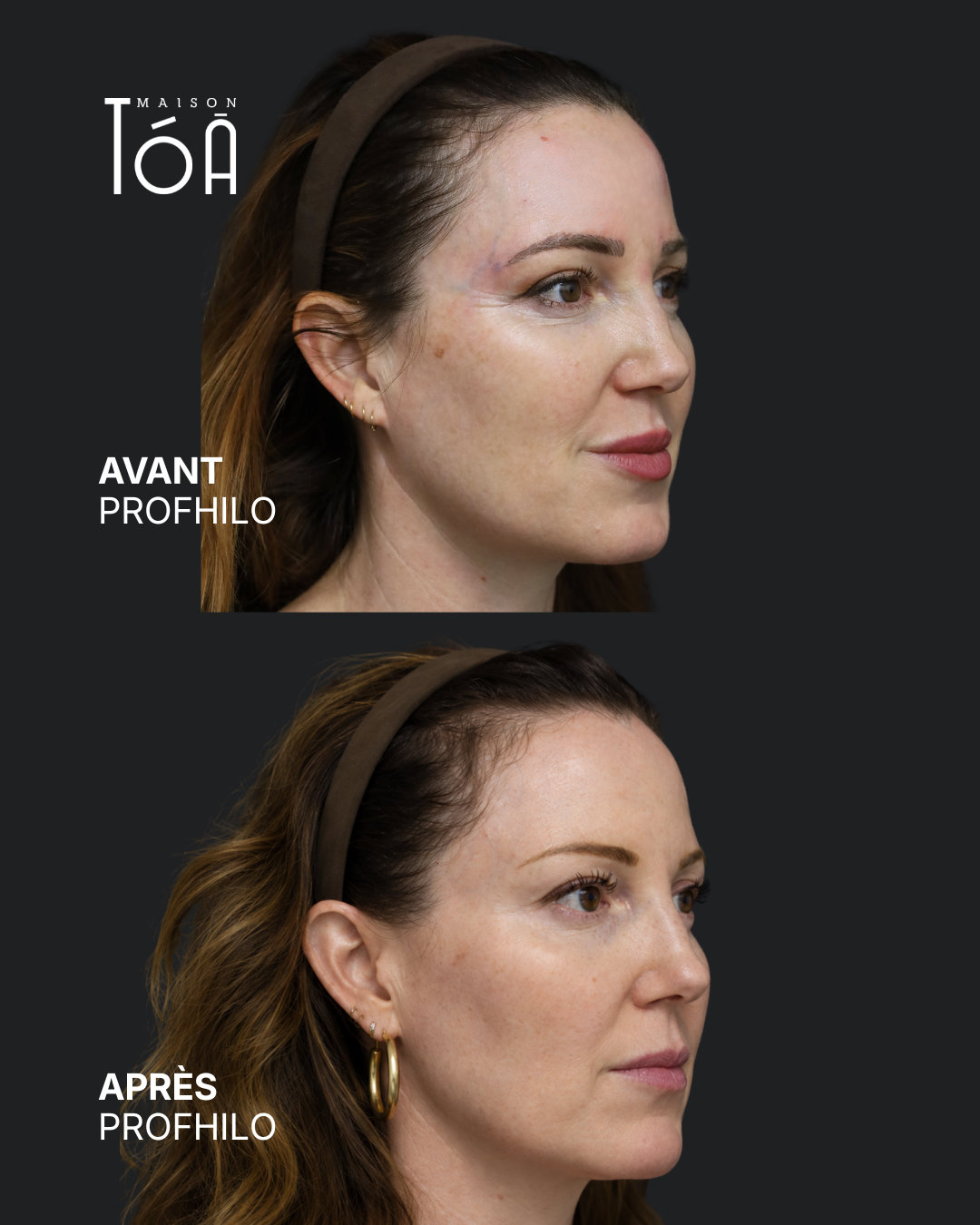 Profhilo® 7 Avant Après profhilo