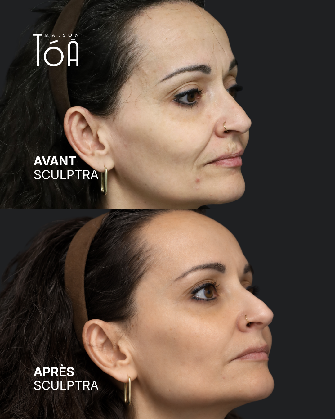 Avant Après sculptra 