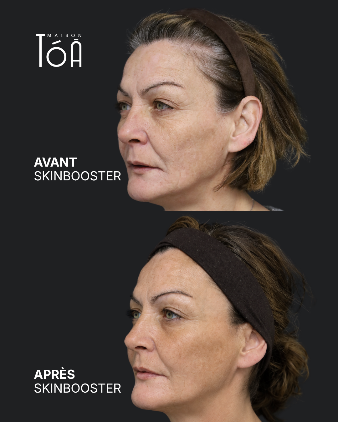 AVANT APRES Skinbooster