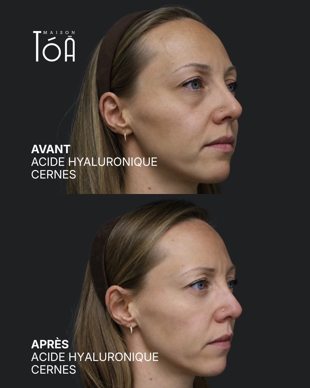 Acide hyaluronique avant après