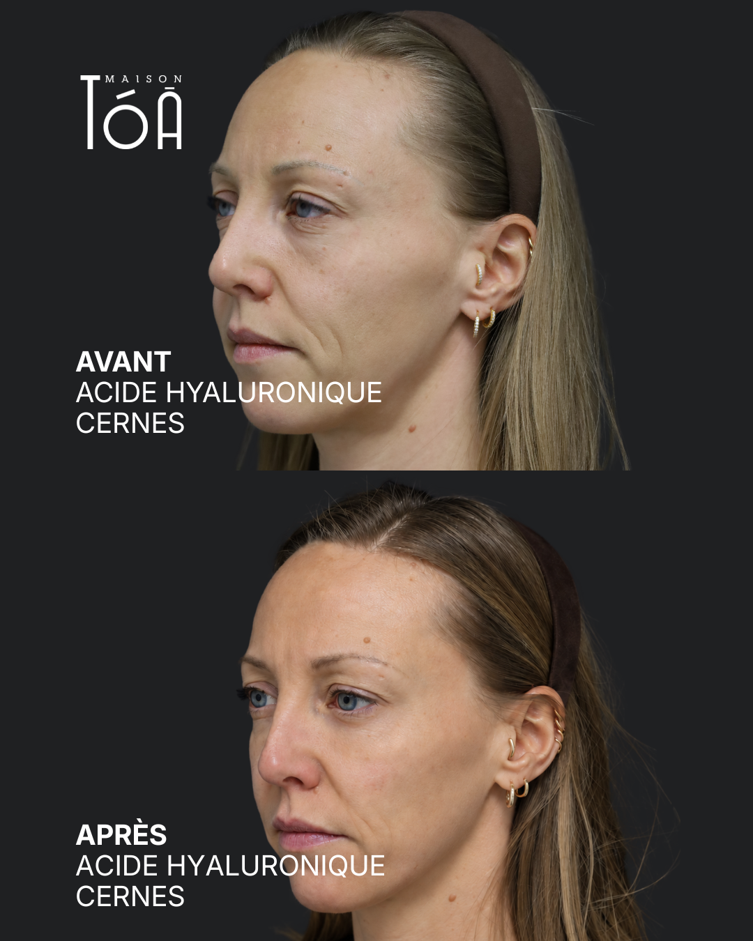 Acide hyaluronique avant après