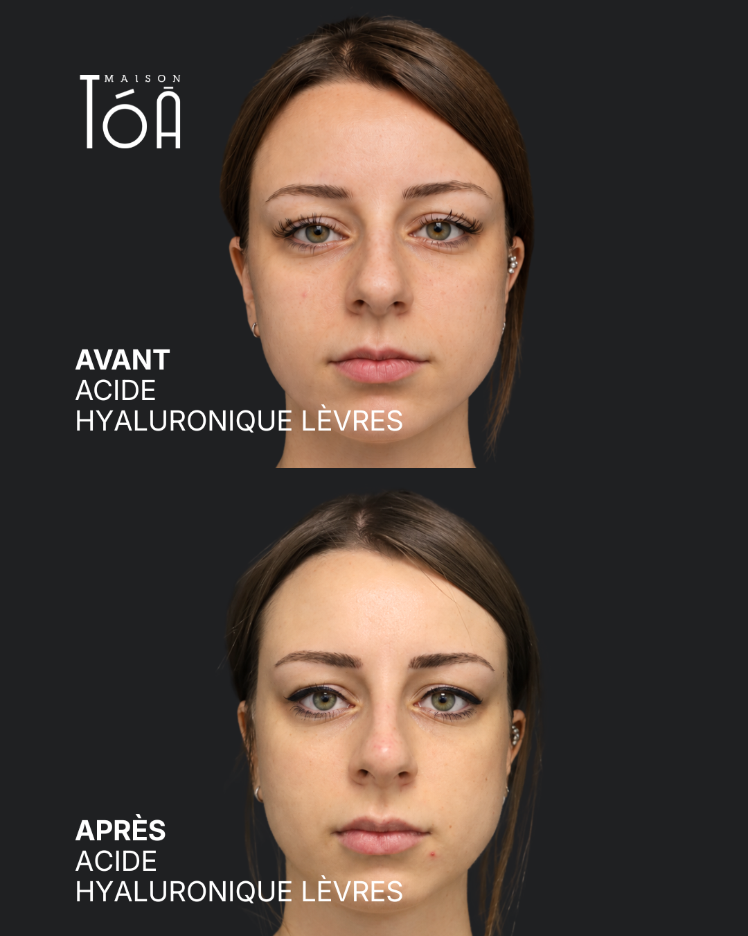 acide hyaluronique avant après lausanne
