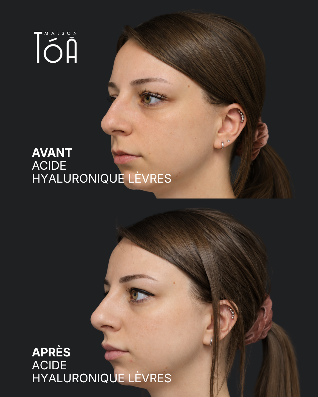 Acide hyaluronique avant après
