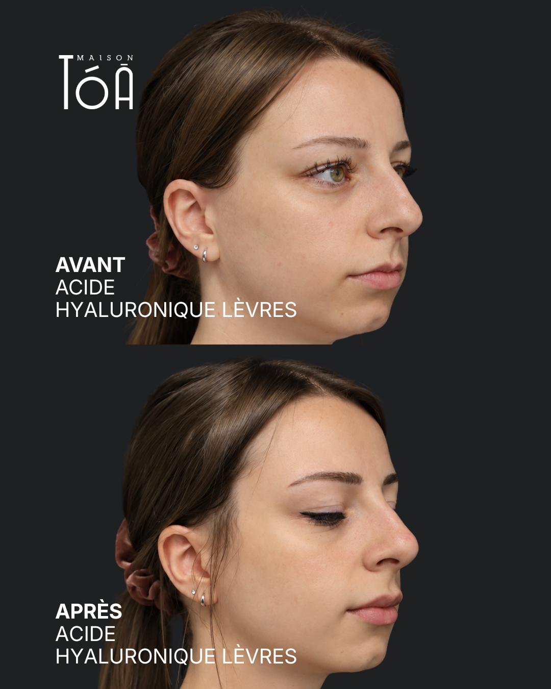 Acide hyaluronique avant après