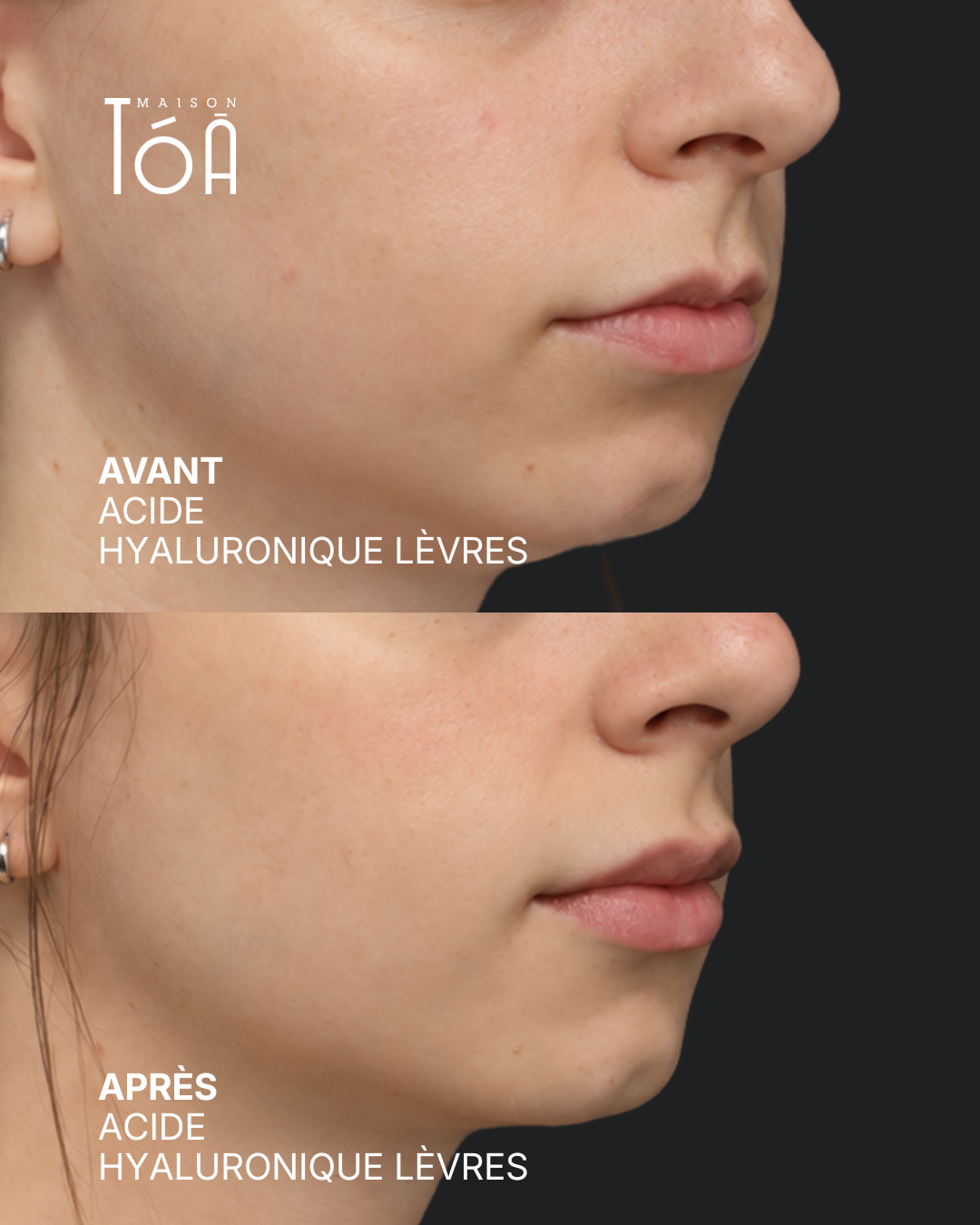 Acide hyaluronique avant après
