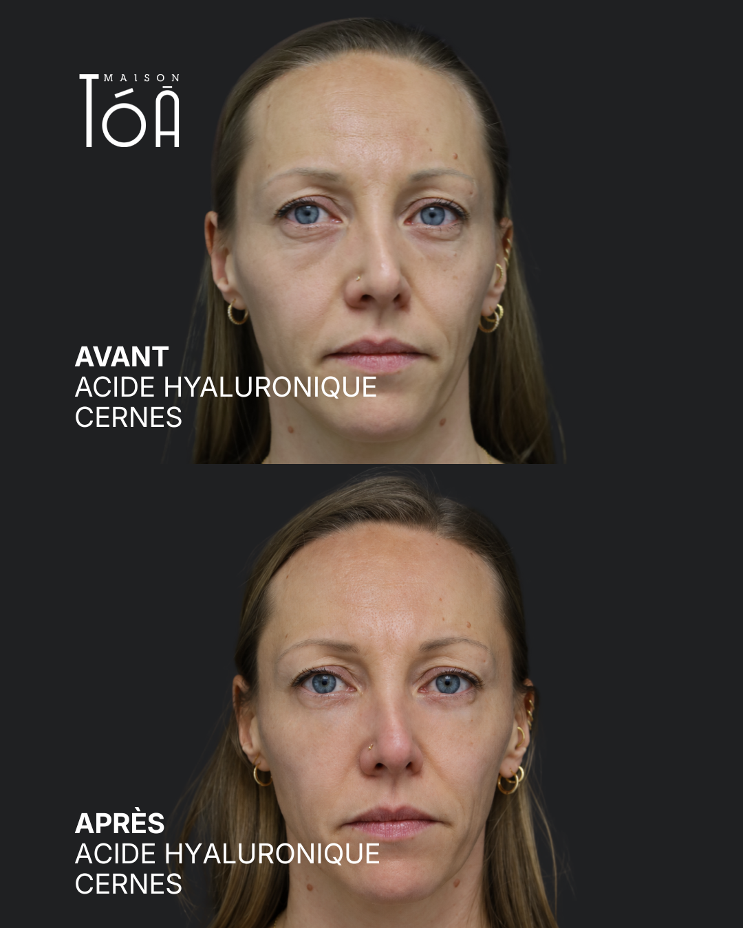 Acide hyaluronique avant après