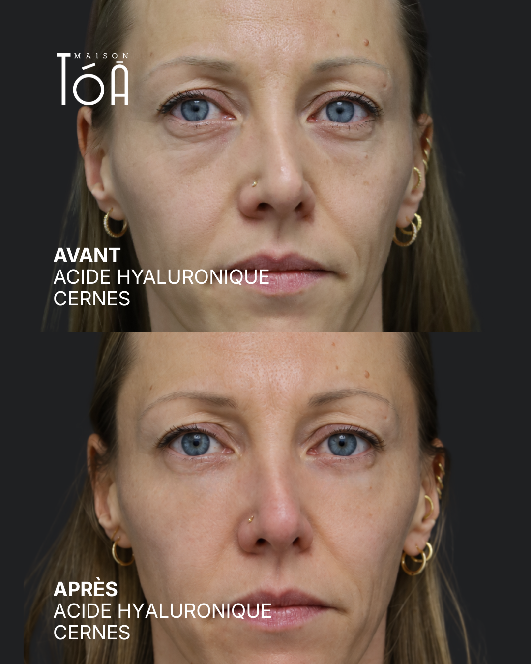 Acide hyaluronique avant après