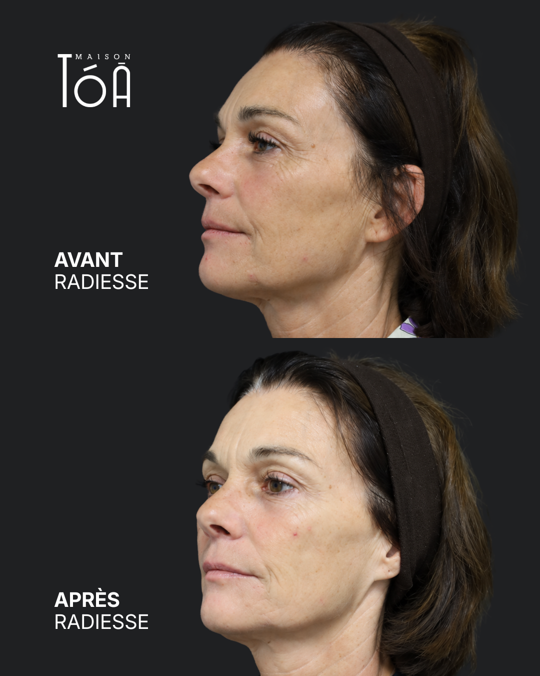AVANT APRES Radiesse