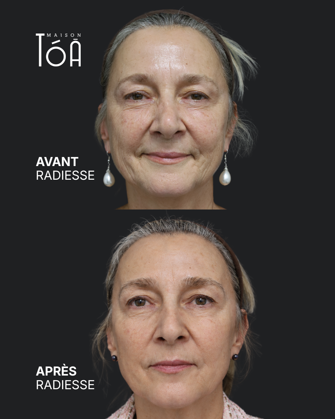 avant après radiesse