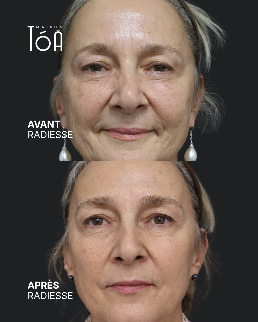 avant après radiesse