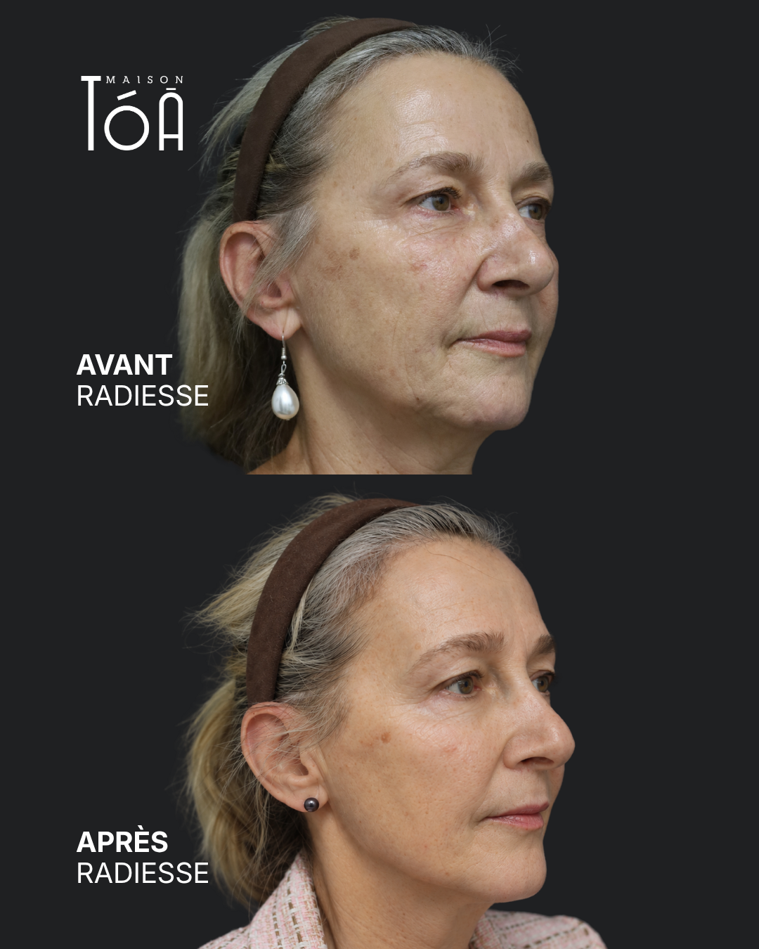 avant après radiesse