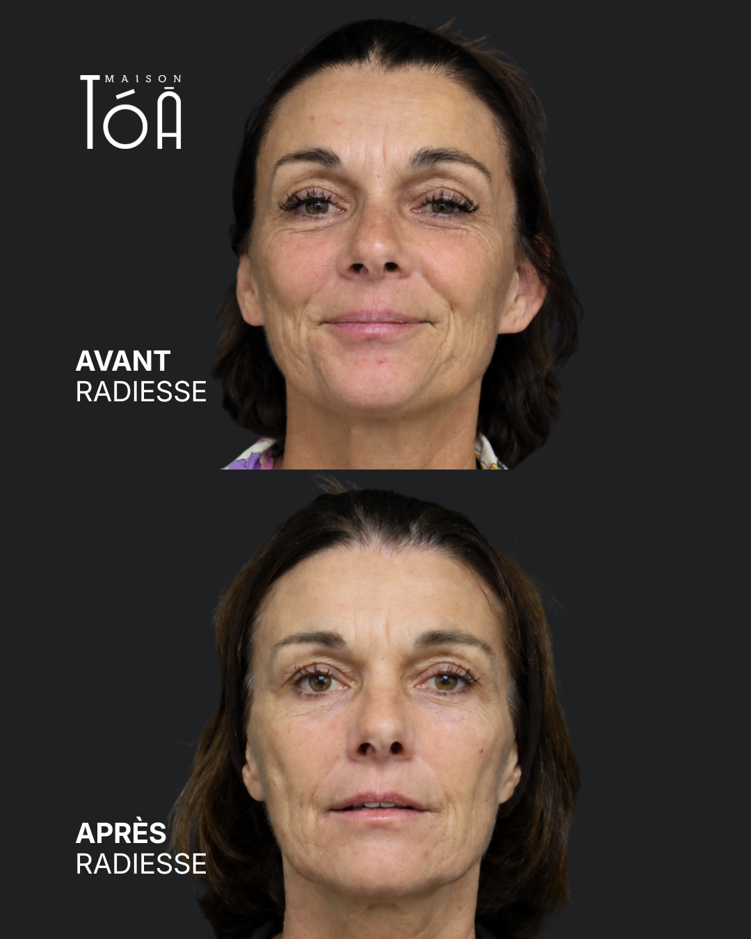 avant après radiesse