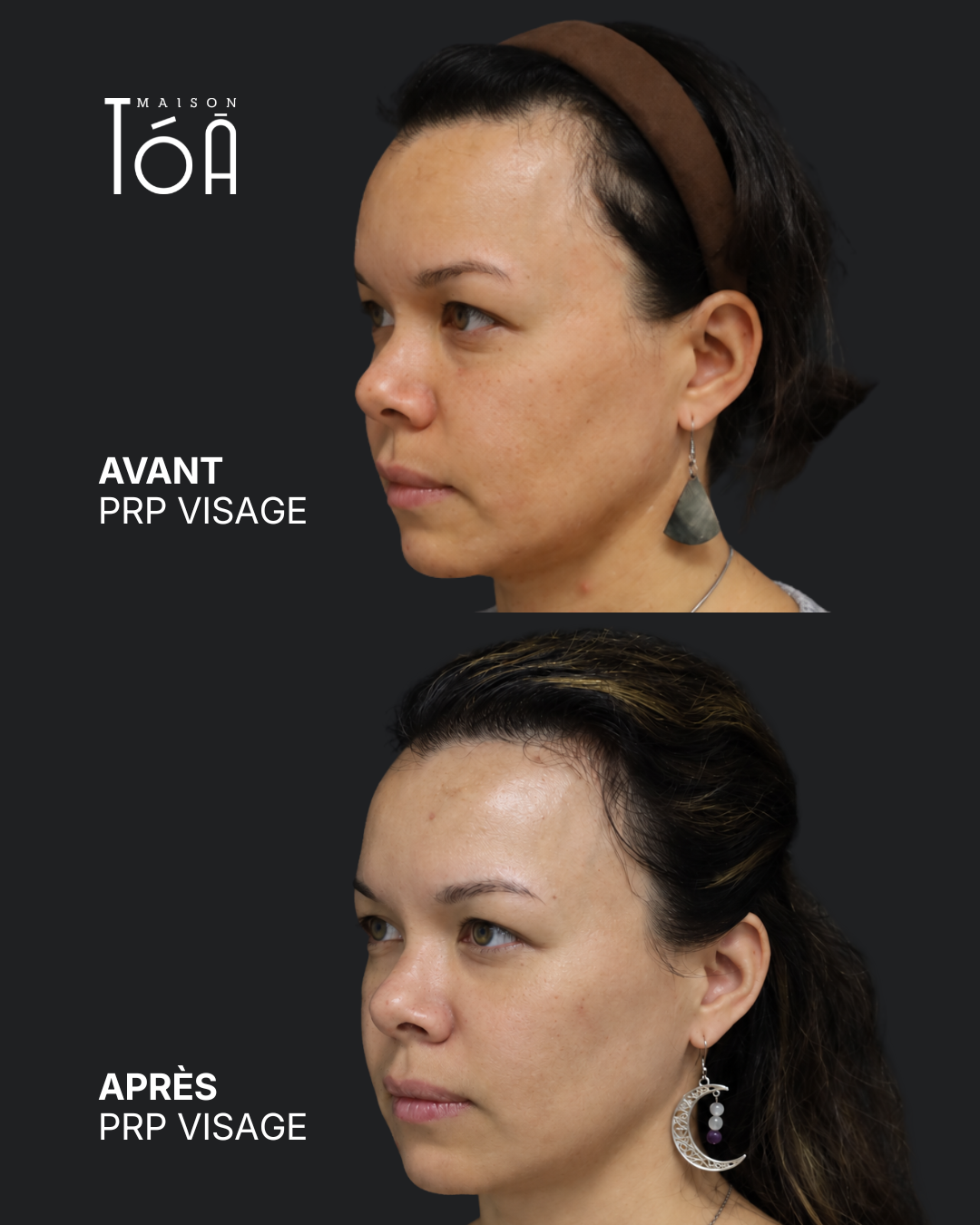 PRP visage avant après