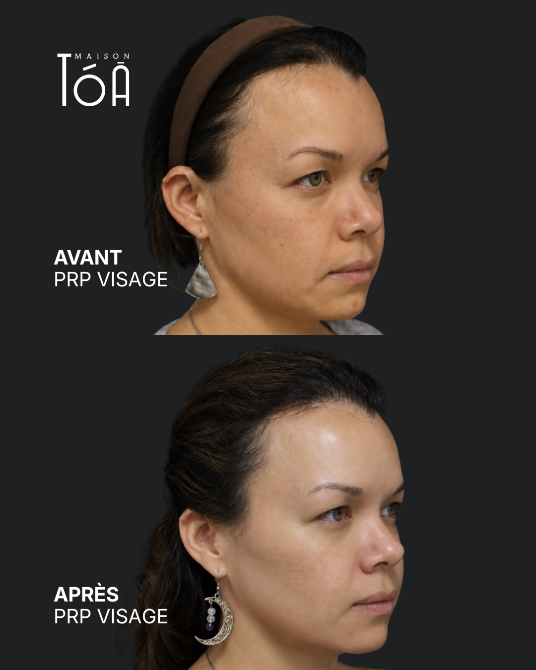 PRP visage avant après