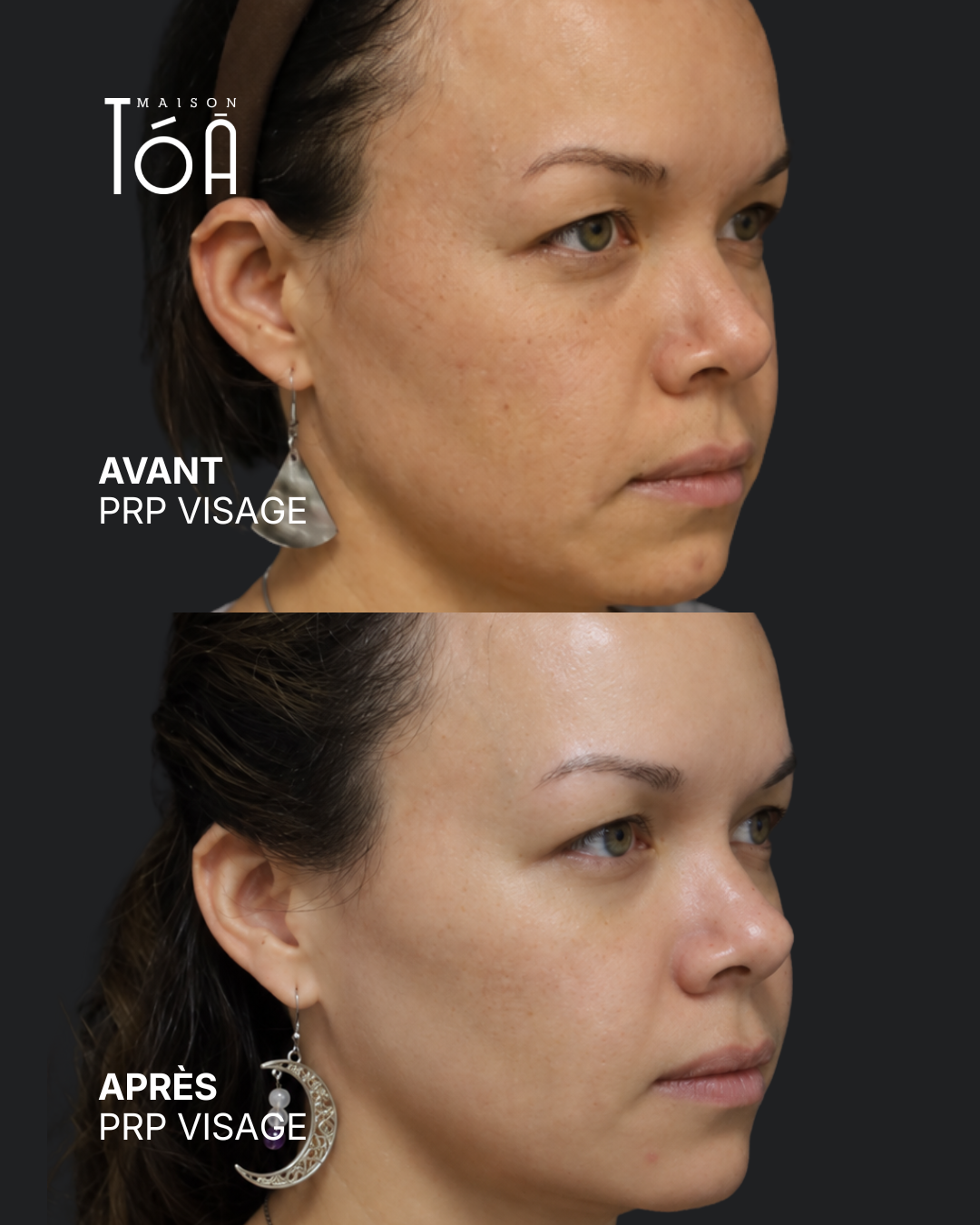 PRP visage avant après