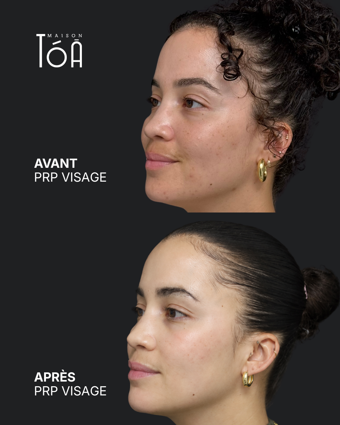 PRP visage avant après