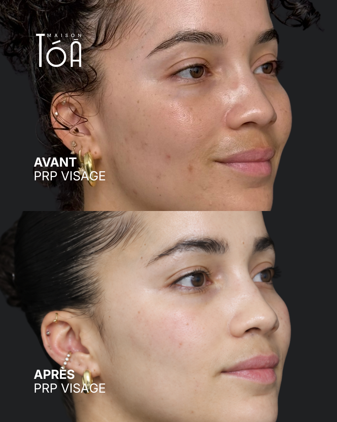PRP visage avant après