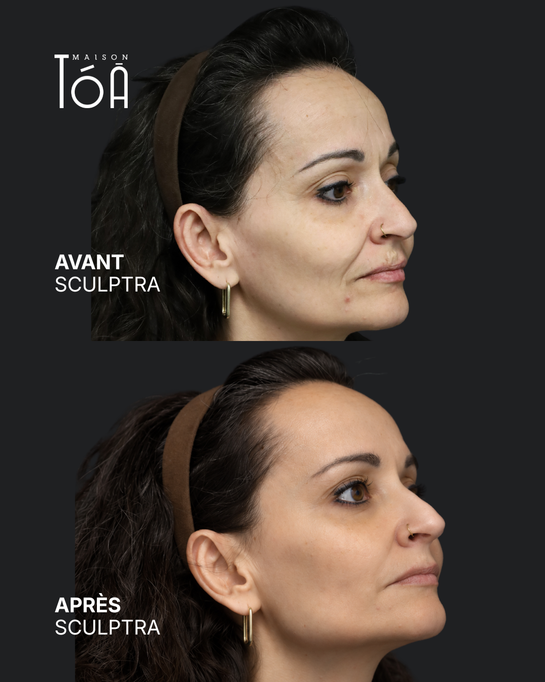 Avant Après sculptra 