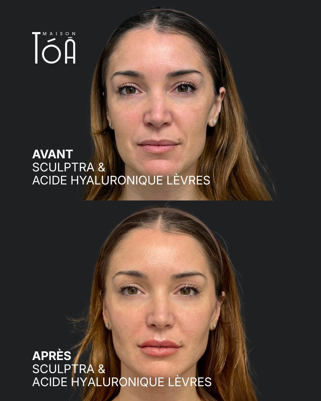 sculptra Après profhilo