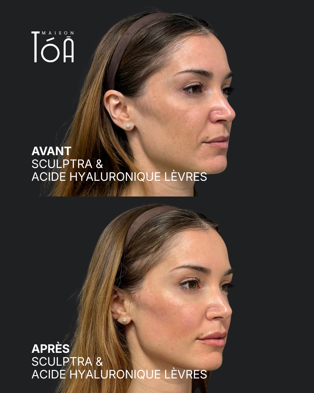sculptra Après profhilo