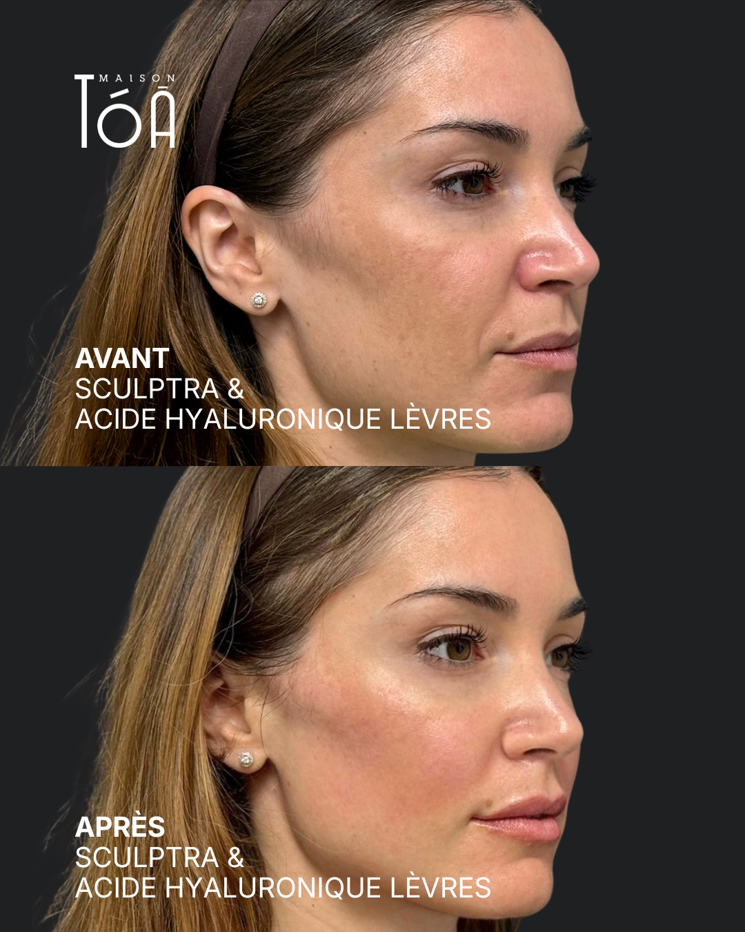 sculptra Après profhilo